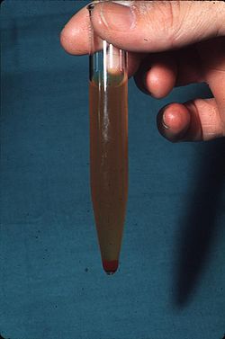 血尿のサムネイル